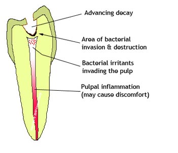 Root Canal Therapy- slider