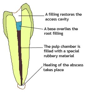 Root Canal Therapy- slider