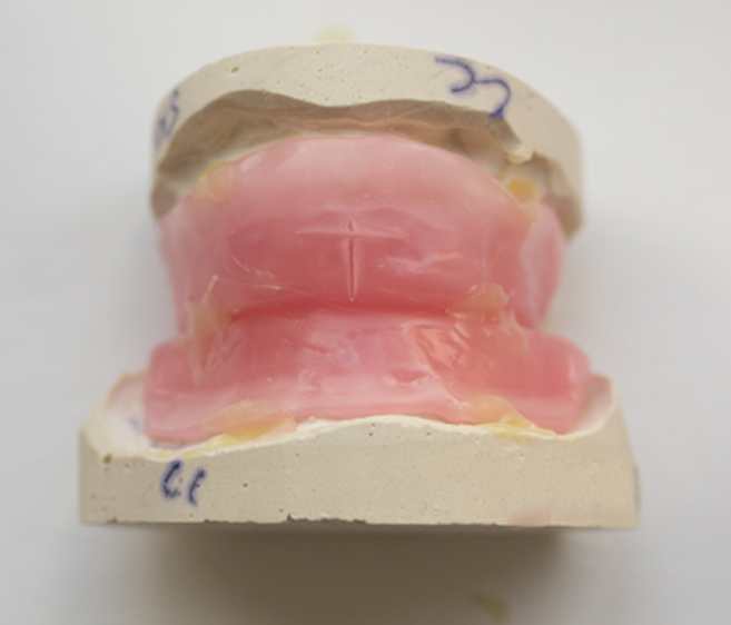 Stages in Denture Construction