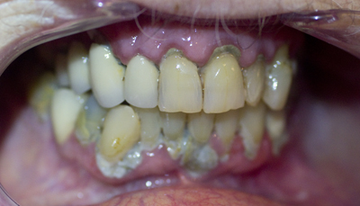 Oral Neglect