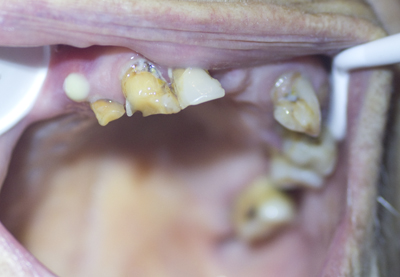 Oral Neglect